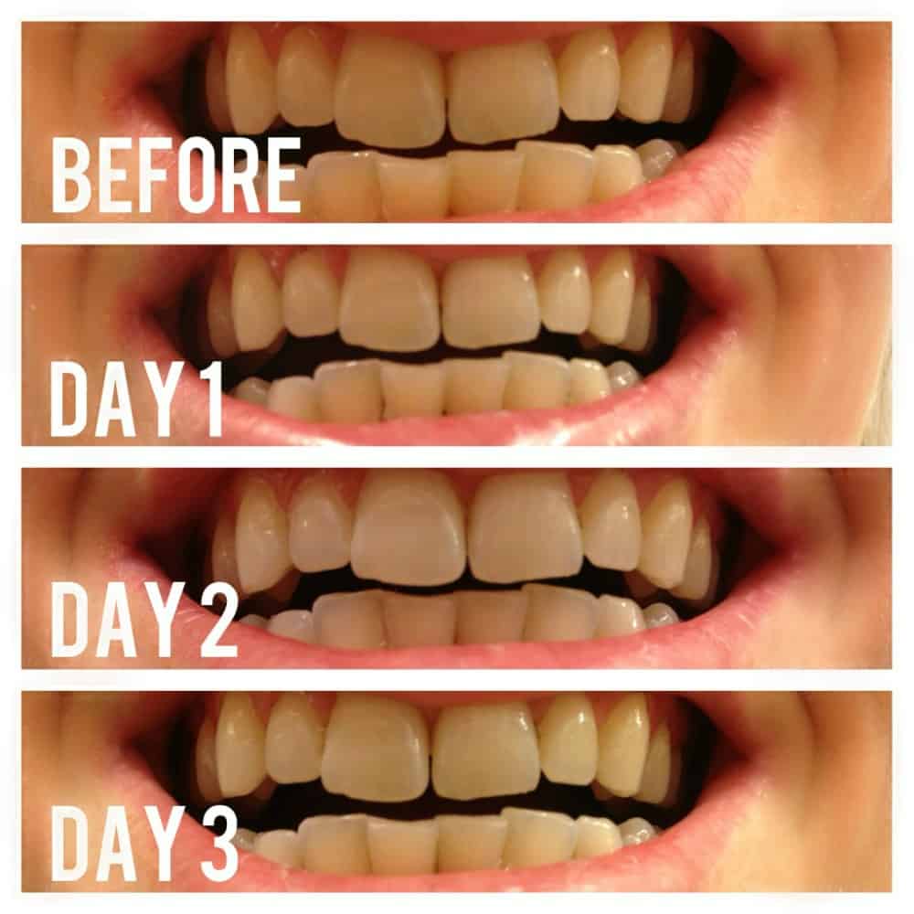 Day 1 - 3 Teeth Whitening With Activated Charcoal