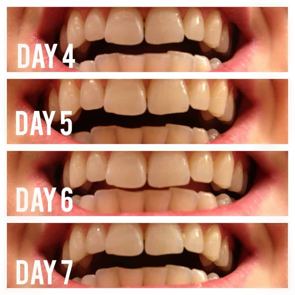 Day 4 - 7 Teeth Whitening With Activated Charcoal