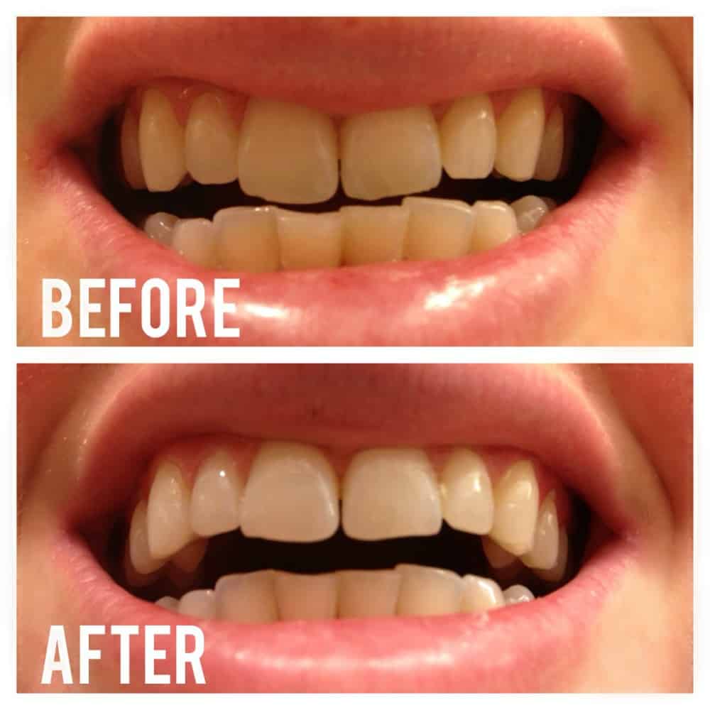 Whitening Your Teeth Naturally With Activated Charcoal